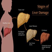 Faze oštećenja jetre Poster Print Monica Schroeder Naučni izvor